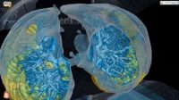 Teknologi VR Tampilkan Gambar Paru-paru Pasien Virus Corona COVID-19